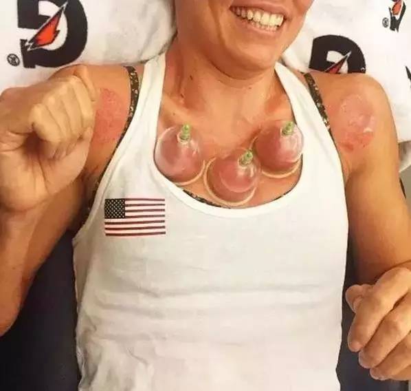 美国游泳冠军拔火罐_外国选手拔罐_美国游泳队拔火罐