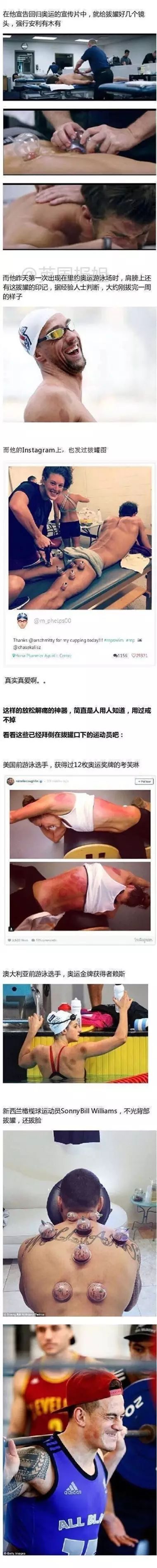 美国游泳队拔火罐_美国游泳冠军拔火罐_外国选手拔罐