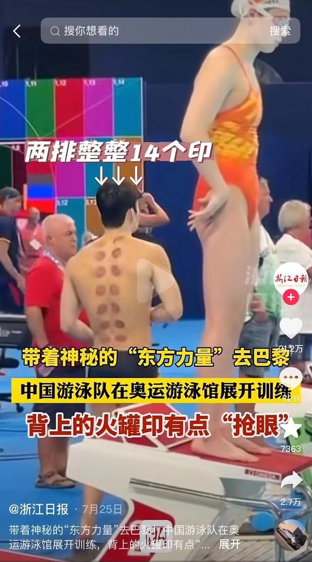 美国游泳队拔火罐_奥运运动员拔火罐_美国游泳冠军拔火罐